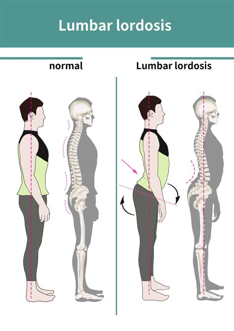 lordosis lumbar - radiculopatia lumbar